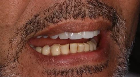 Faccette roma prati studio dentistico Romano Mei Caldora