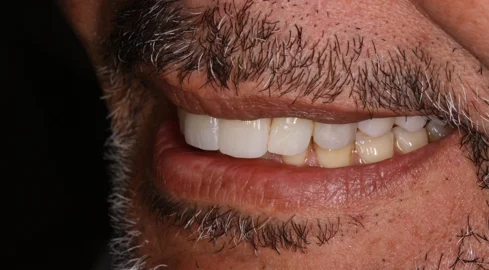 Ricostruzione estetica del sorriso con faccette - Via Cicerone 44 Roma