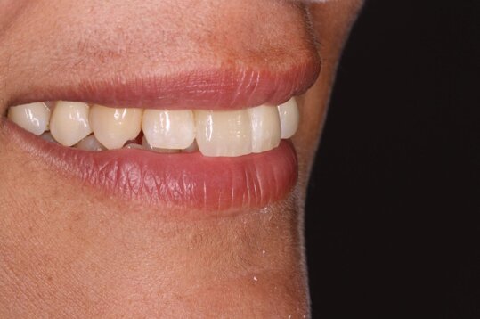 Estetica dentale prima e dopo faccette - Studio Dentistico Antonio Romano Mei Caldora