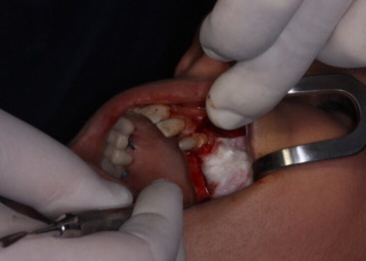 chirurgia deel seno mascellare dentista roma
