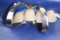 dentista roma faccette in ceramica e faccette in porcellana