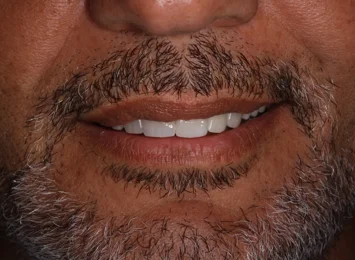 invisalign%20romano%20mei%20caldora.jpeg