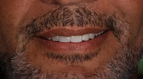 Faccette dentali in ceramica prima e dopo - Dott. Antonio Romano Mei Caldora Roma Prati