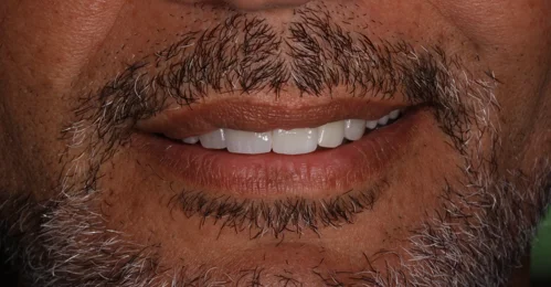 invisalign%20romano%20mei%20caldora.jpeg