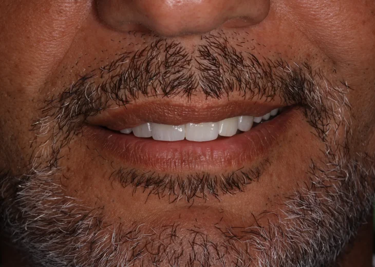 faccette estetica dott. antonio romano mei caldora