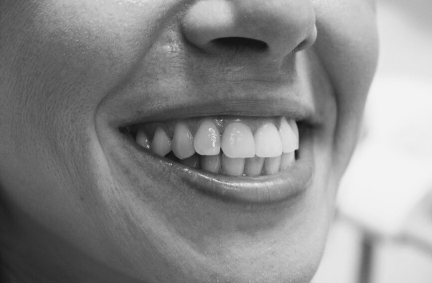 Risultato trattamento faccette dentali estetiche Roma Prati