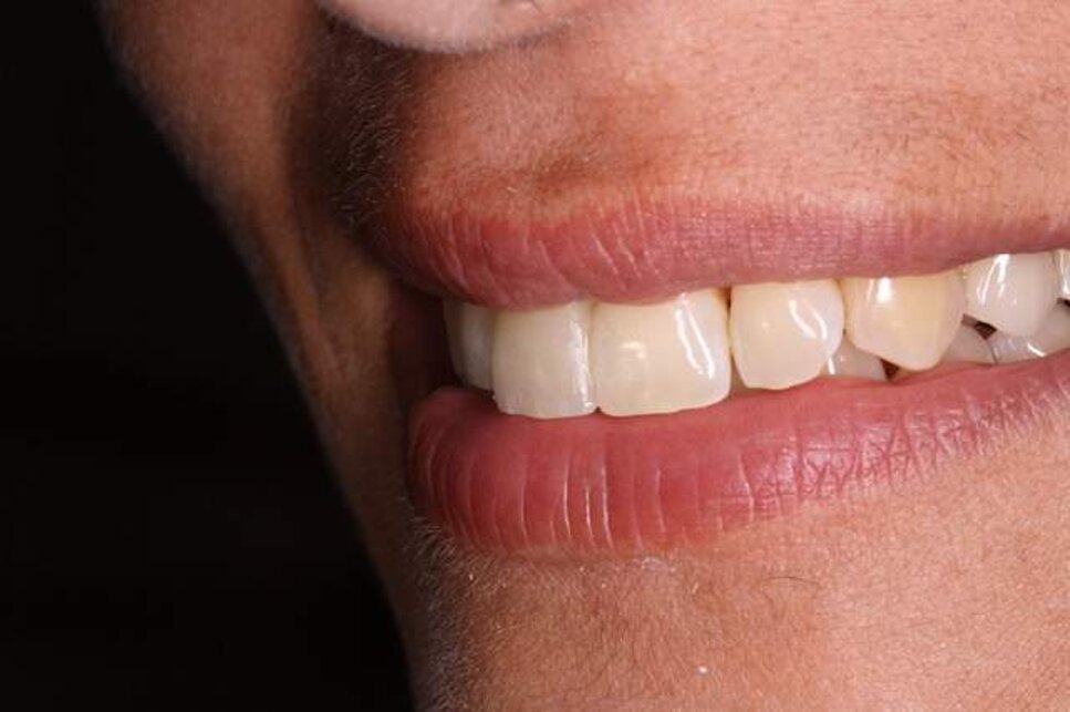 incisivi centrali estetica faccette roma studio dentistico