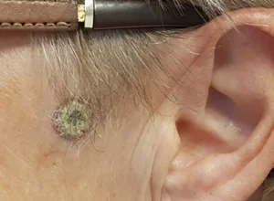 Carcinoma spinocellulare preauricolare