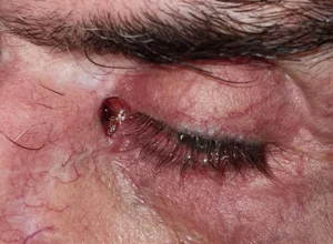 Carcinoma spinocellulare canto interno