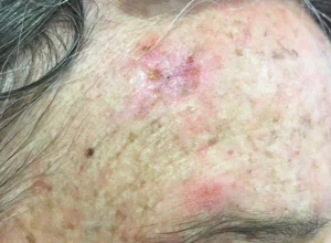 Carcinoma spinocellulare fronte