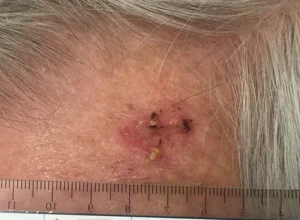 Carcinoma spinocellulare fronte