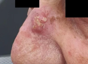 Carcinoma spinocellulare naso