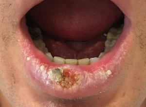 Carcinoma spinocellulare labbro