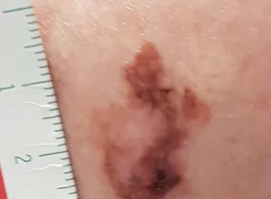 Melanoma gamba