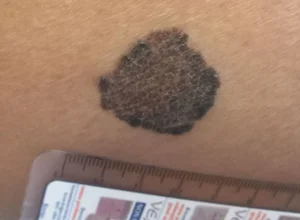 Melanoma gamba