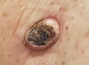 Cheratoacantoma dorso