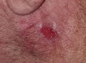 Carcinoma spinocellulare palpebra
