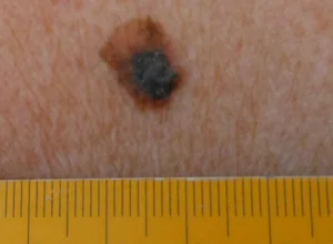 Melanoma dorso