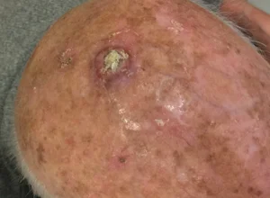 Carcinoma spinocellulare cuoio capelluto