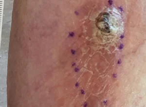 Carcinoma spinocellulare gamba