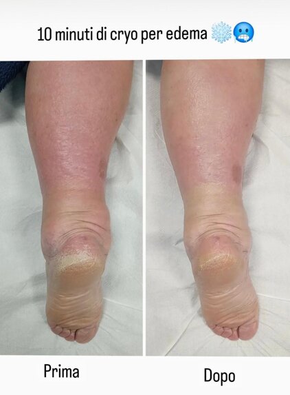 edema cryo.jpeg edema cryo.jpeg