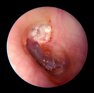 colesteatoma.jpeg colesteatoma.jpeg