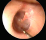 sindrome di maniere sindrome di maniere