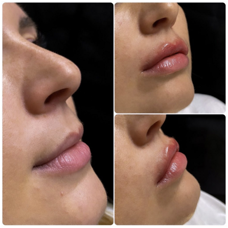 trattamenti acido ialuronico