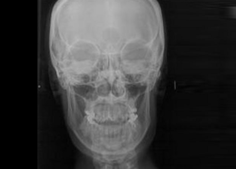 radiografia cranio radiografia cranio
