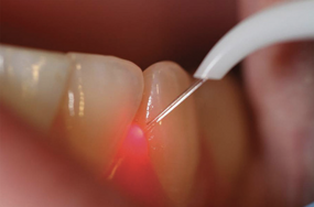 terapie con laser per patologie del cavo orale terapie con laser per patologie del cavo orale