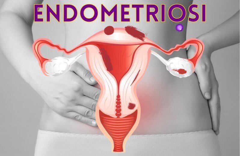 Endometriosi Ceccaroni metodo Negrar