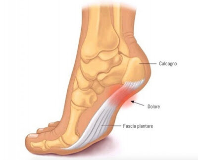 FASCITE PLANTARE FASCITE PLANTARE