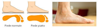 PIEDE PIATTO