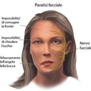 PARALISI DI BELL
