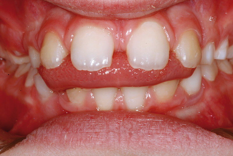 LINGUA E DEGLUTIZIONE