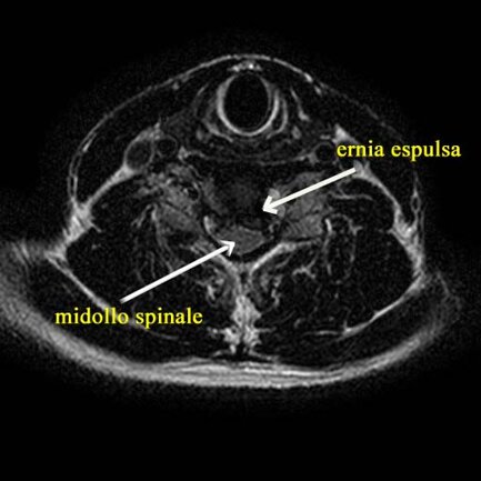 Ozonoterapia ecoguidata Milano e Parabiago comoda con la Svizzera dettaglio ernia espulsa midollo spinale Ozonoterapia ecoguidata Milano e Parabiago comoda con la Svizzera dettaglio ernia espulsa midollo spinale