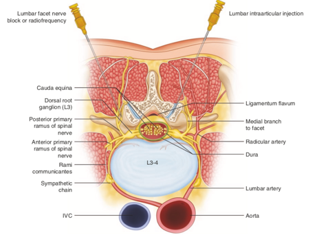 Ozonoterapia ecoguidata Milano Parabiago sindrome faccette lombari articolari scanner 3 Ozonoterapia ecoguidata Milano Parabiago sindrome faccette lombari articolari scanner 3