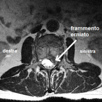 Ozonoterapia ecoguidata Milano e Parabiago comoda con la Svizzera dettaglio frammento erniato 1 Ozonoterapia ecoguidata Milano e Parabiago comoda con la Svizzera dettaglio frammento erniato 1