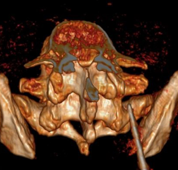 Ozonoterapia ecoguidata Milano Parabiago sindrome faccette lombari articolari radiografia Ozonoterapia ecoguidata Milano Parabiago sindrome faccette lombari articolari radiografia