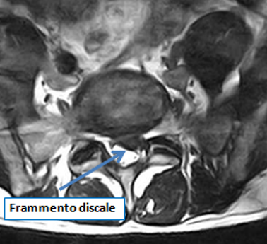 Ozonoterapia ecoguidata Milano e Parabiago comoda con la Svizzera dettaglio frammento discale Ozonoterapia ecoguidata Milano e Parabiago comoda con la Svizzera dettaglio frammento discale