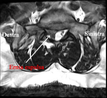 Ozonoterapia ecoguidata Milano e Parabiago comoda con la Svizzera dettaglio ernia espulsa 1 Ozonoterapia ecoguidata Milano e Parabiago comoda con la Svizzera dettaglio ernia espulsa 1