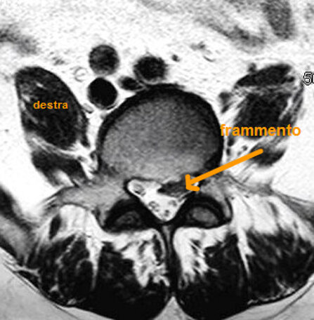 Ozonoterapia ecoguidata Milano e Parabiago comoda con la Svizzera dettaglio erniato 3 Ozonoterapia ecoguidata Milano e Parabiago comoda con la Svizzera dettaglio erniato 3