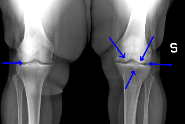 Ozonoterapia ecoguidata Milano Parabiago artrosi del ginocchio vista frontale