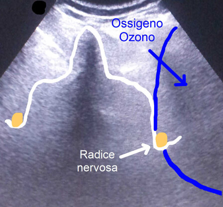 Ozonoterapia ecoguidata Milano e Parabiago comoda con la Svizzera ossigeno ed azoto sulla radice nervosa