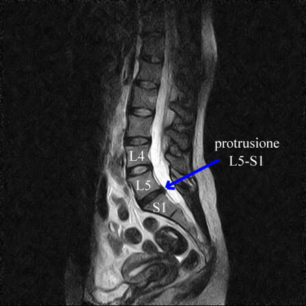 Ozonoterapia ecoguidata Milano e Parabiago comoda con la Svizzera dettaglio protrusione L5-S1 colonna vertebrale Ozonoterapia ecoguidata Milano e Parabiago comoda con la Svizzera dettaglio protrusione L5-S1 colonna vertebrale