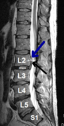 Ozonoterapia ecoguidata Milano e Parabiago comoda con la Svizzera ernia vertebrale Ozonoterapia ecoguidata Milano e Parabiago comoda con la Svizzera ernia vertebrale