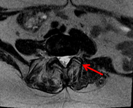 Ozonoterapia ecoguidata Milano Parabiago sindrome faccette lombari articolari evidenza 2 Ozonoterapia ecoguidata Milano Parabiago sindrome faccette lombari articolari evidenza 2