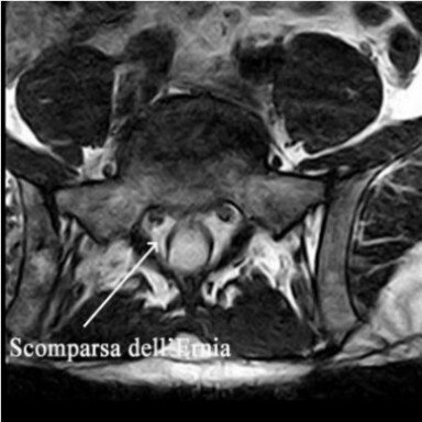 Ozonoterapia ecoguidata Milano e Parabiago comoda con la Svizzera dettaglio scomparsa della ernia Ozonoterapia ecoguidata Milano e Parabiago comoda con la Svizzera dettaglio scomparsa della ernia