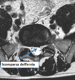 Ozonoterapia ecoguidata Milano e Parabiago comoda con la Svizzera dettaglio scomparsa della ernia 3 Ozonoterapia ecoguidata Milano e Parabiago comoda con la Svizzera dettaglio scomparsa della ernia 3