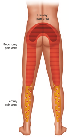 Ozonoterapia ecoguidata Milano Parabiago sindrome faccette articolari zone del dolore Ozonoterapia ecoguidata Milano Parabiago sindrome faccette articolari zone del dolore